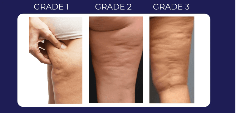 visualisation des grades cellulite