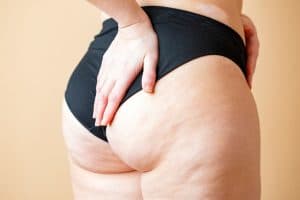 femme avec cellulite devant un fond beige